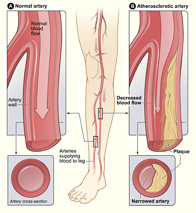 Vascular Surgery for Heart Attack, Stroke, or PAD.gif